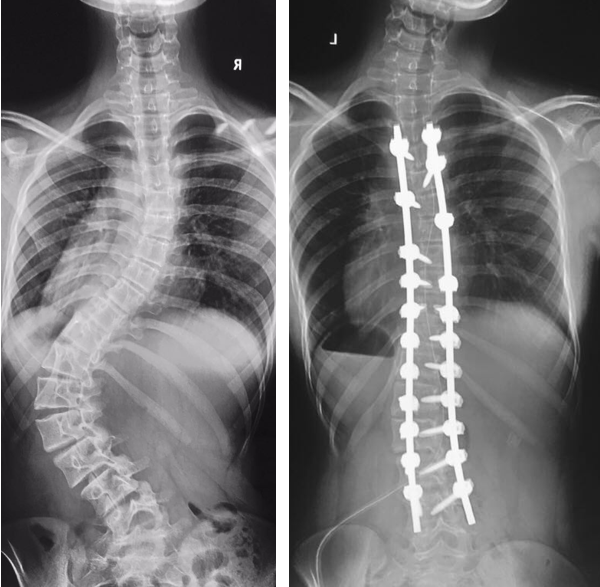 Spine Surgery Hospital in Pune